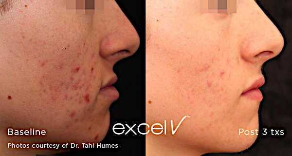 Leczenie trądziku Laserem Cutera Excel V - redukcja stanów zapalnych skóry twarzy