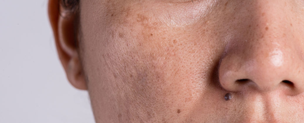 Duże zbliżenie na przebarwienia na twarzy w okolicach policzka