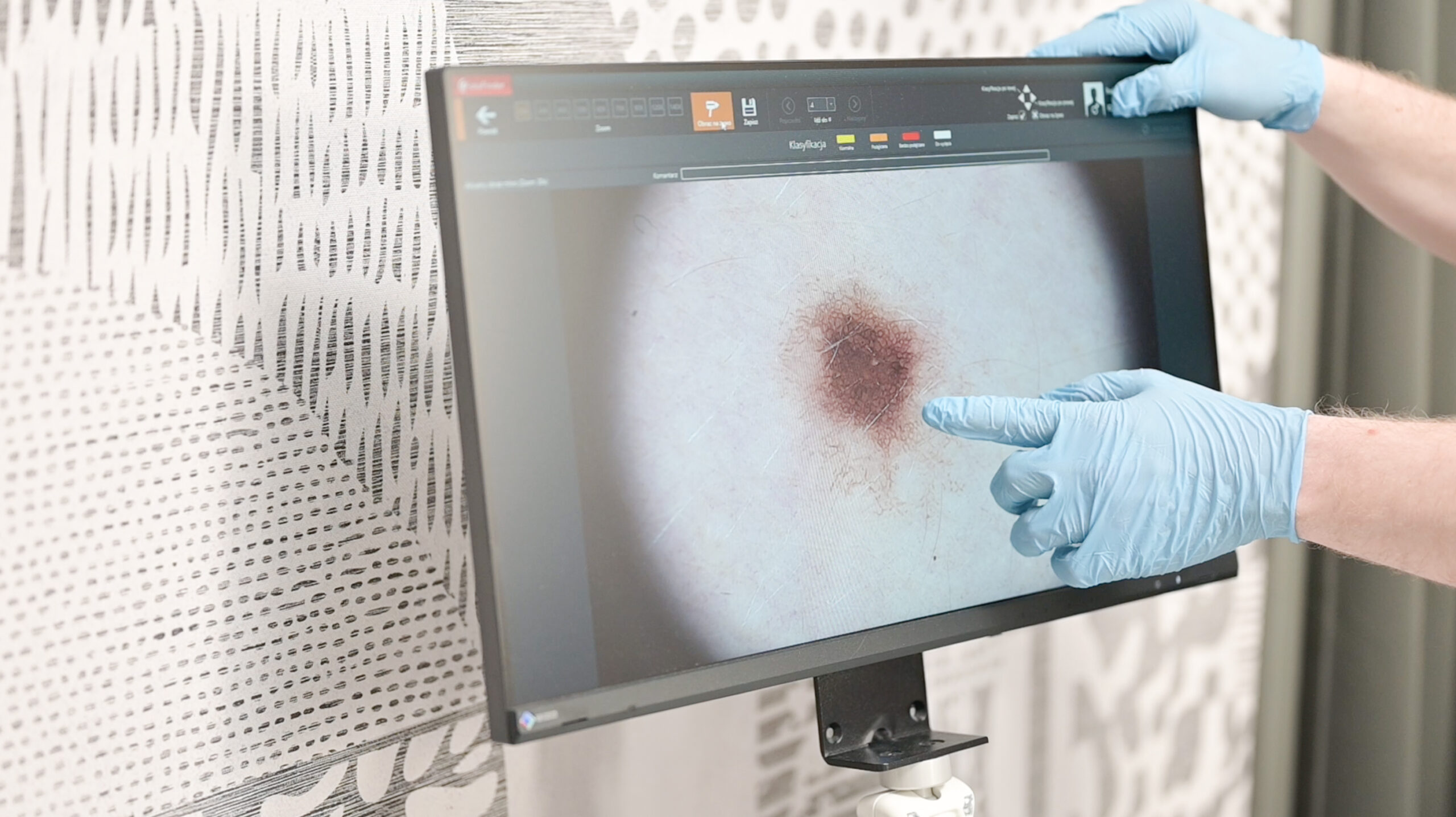 Lekarz dermatolog wskazujący zmianę skórną na ekranie urządzenia do wideodermatoskopii