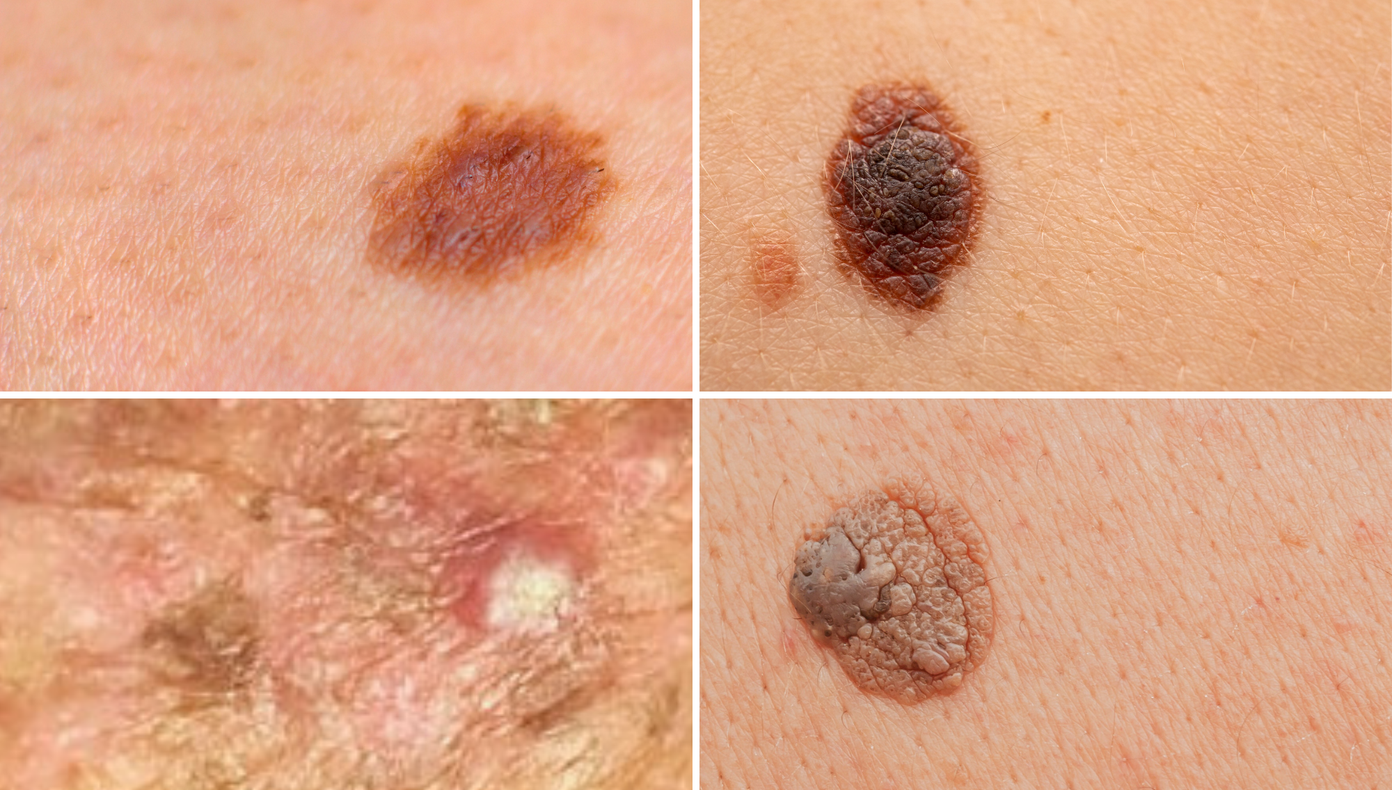 Zmiany skórne, które mają wskazanie do badania wideodermatoskopowego i ewentualnego usuwania.