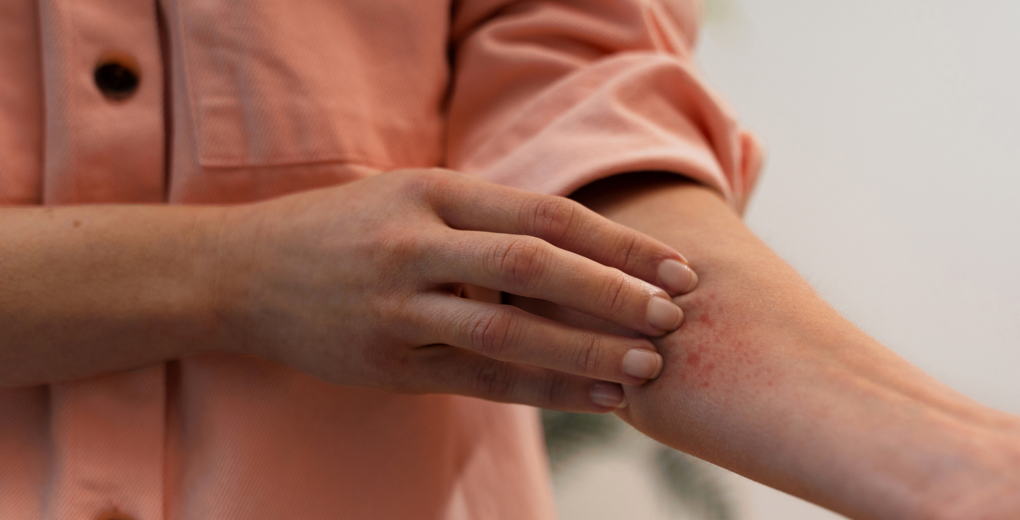 Wysypka od mrozu, czyli pokrzywka z zimna - uczulenie na zimno?