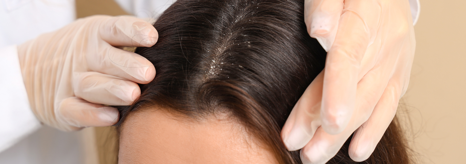 Łupież zimą - objawy, przyczyny i leczenie