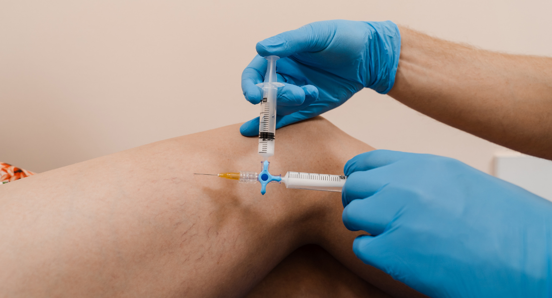 Ostrzykiwanie (telenagiektazje) pajączków naczyniowych na udach pacjentki