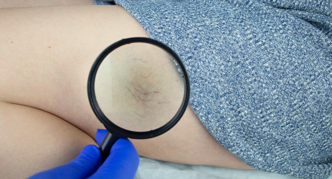 Pajączki, zmiany naczyniowe, na udach pacjentki.