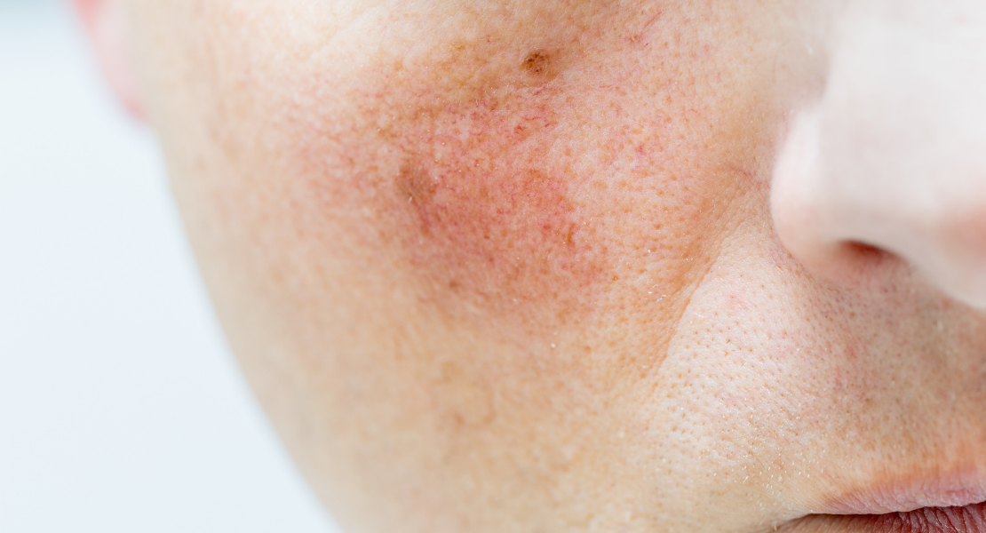 Popękane naczynka zimą - objawy, przyczyny i sposoby leczenia