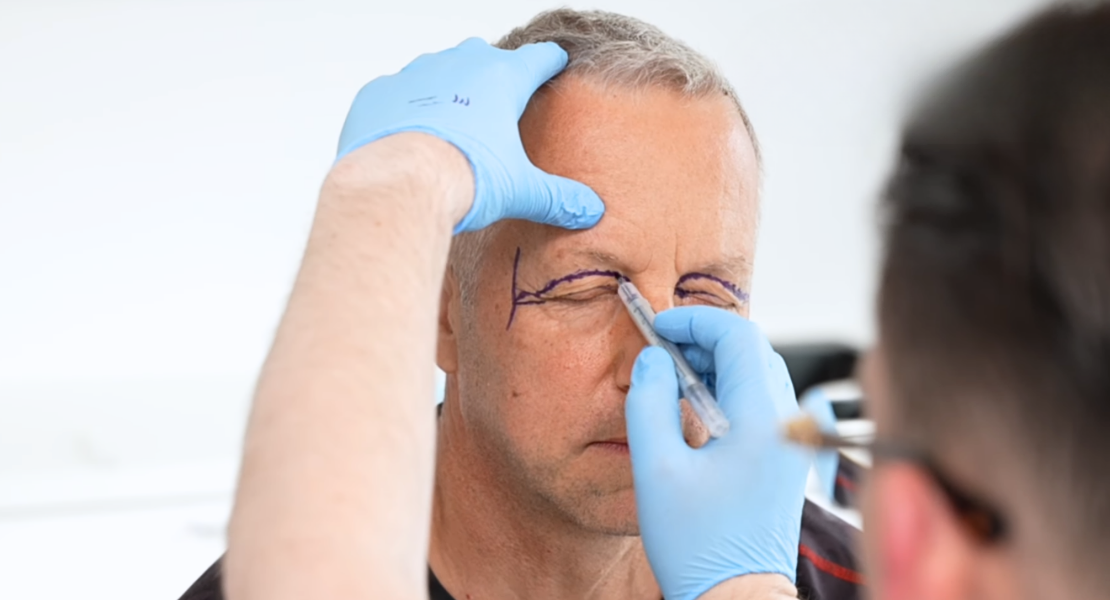 Chirurg plastyczny zaznacza na twarzy pacjenta miejsca, w których będzie wykonywana blefaroplastyka.