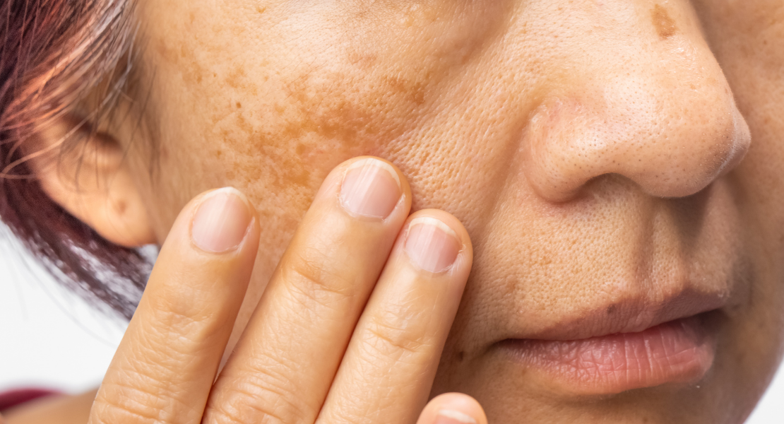 Plamy pigmentacyjne na twarzy i ciele - rodzaje, przyczyny i skuteczne usuwanie