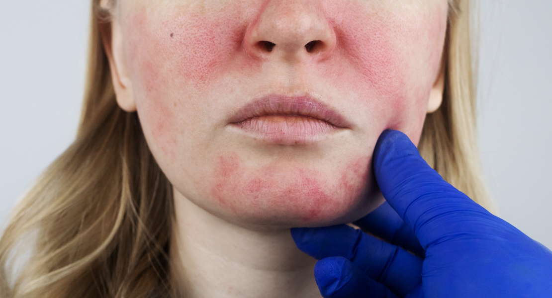 Pieczenie skóry twarzy i ciała - jak odróżnić alergię od podrażnienia?