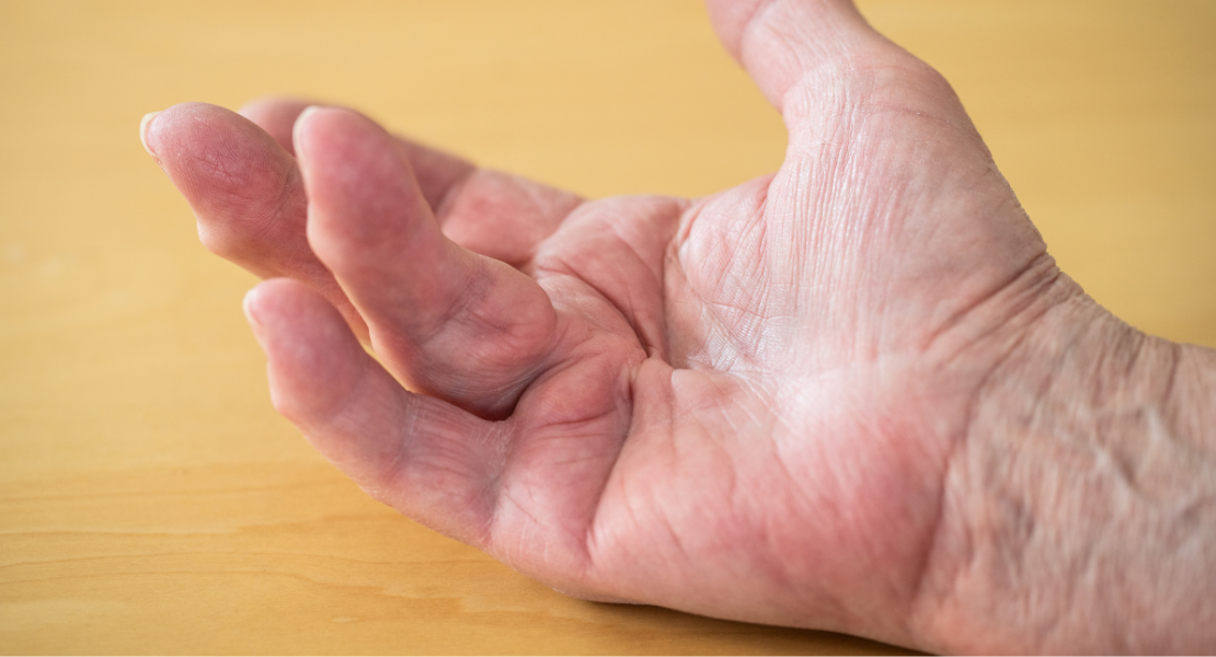 Zbliżenie na dłoń starszej osoby z widocznym przykurczem palców (serdecznego i małego) w kierunku wnętrza dłoni, co jest charakterystycznym objawem choroby Dupuytrena.