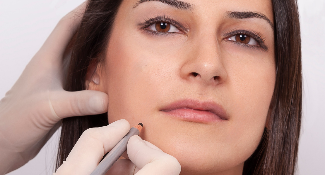 Chirurg w białych rękawiczkach zaznacza czarną kredką linię cięcia pod nosem pacjentki, przygotowując ją do zabiegu modelowania ust.